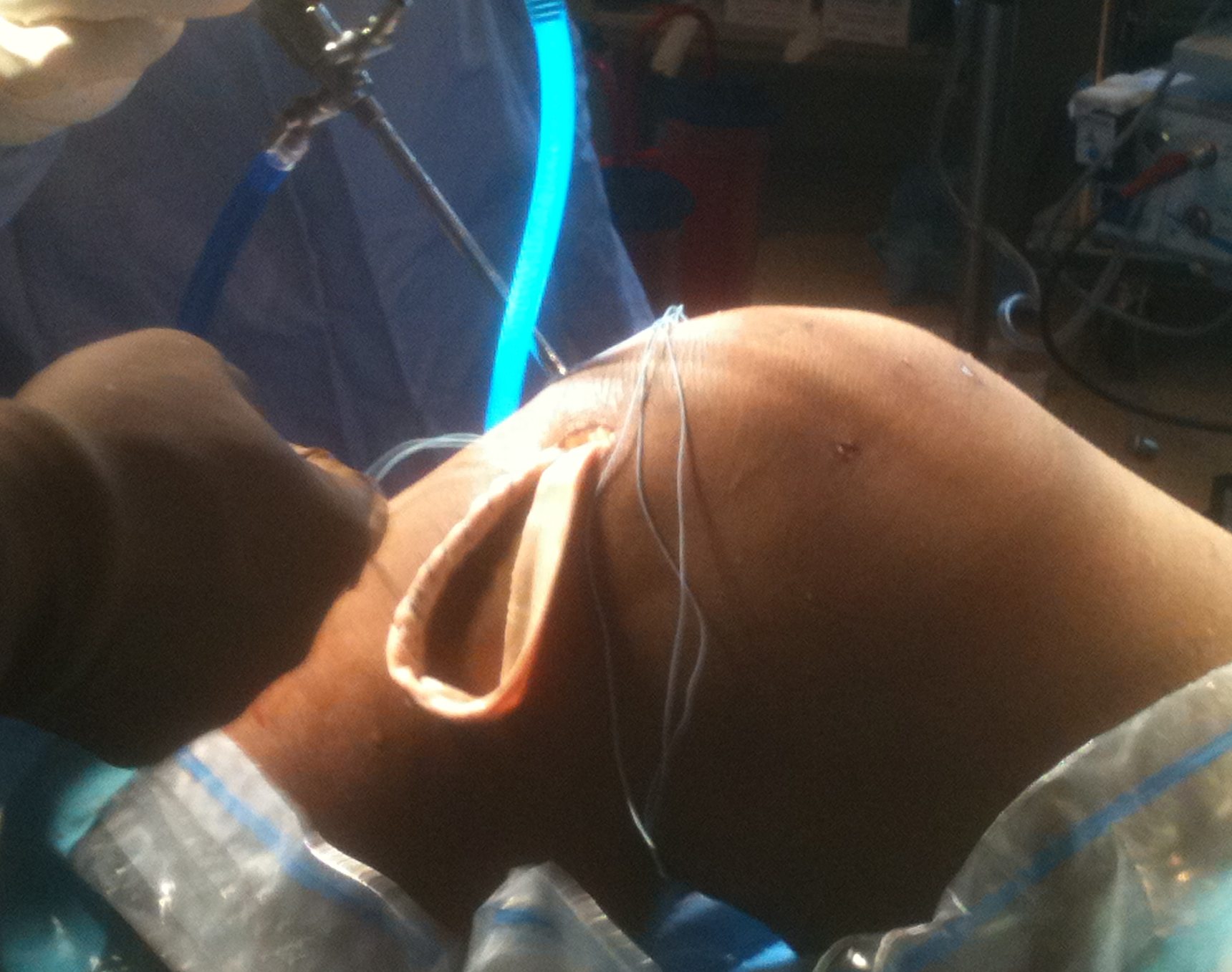 PCL Allograft tibial component into knee